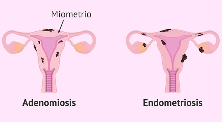 Endometriosis y adenomiosis