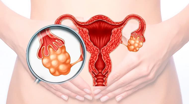 Síndrome de ovario poliquístico