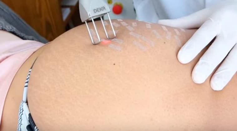 Corrección de cicatrices y estrías por láser