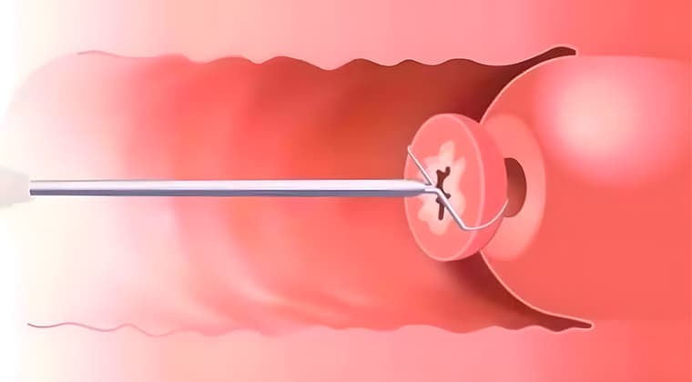 Electrocirugía y criocirugía