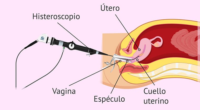 Histeroscopia