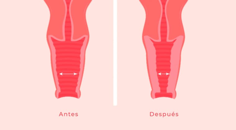 Rejuvenecimiento y tensado vaginal