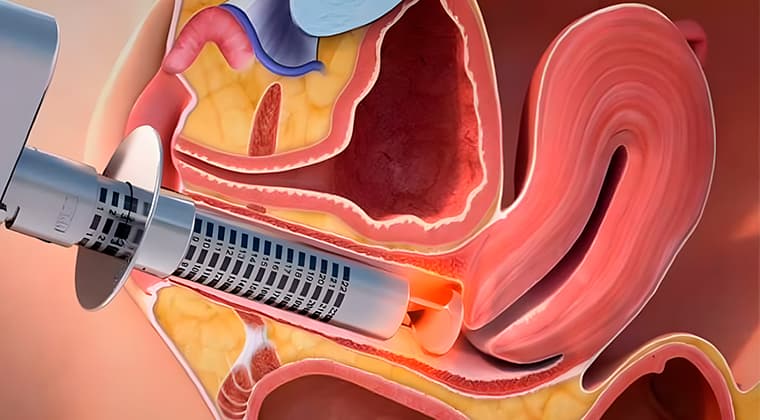 Terapia regenerativa láser