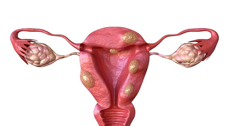 Miomas uterinos