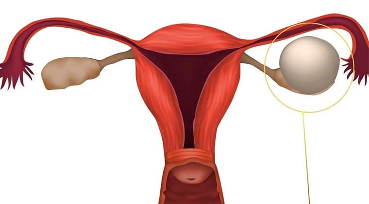 Quistes de ovario
