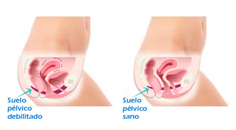 Trastornos de piso pélvico