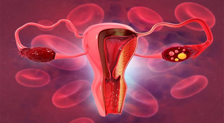 Sangrado uterino anormal